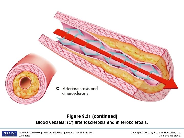 Figure 9. 21 (continued) Blood vessels: (C) arteriosclerosis and atherosclerosis. Medical Terminology: A Word-Building