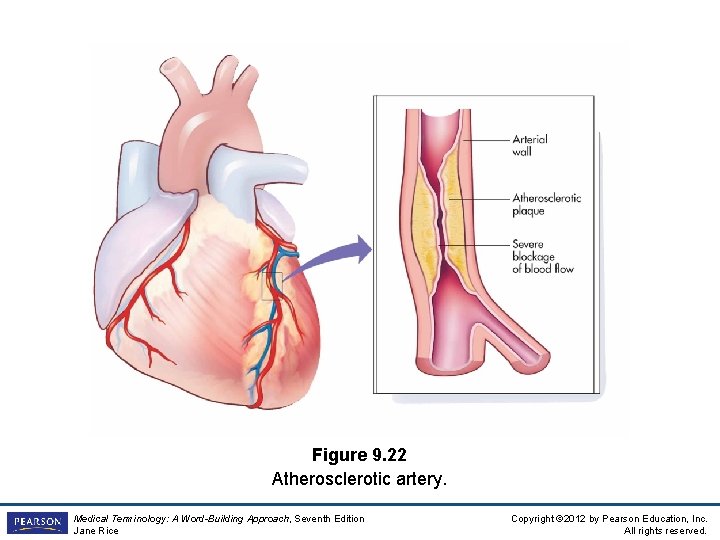 Figure 9. 22 Atherosclerotic artery. Medical Terminology: A Word-Building Approach, Seventh Edition Jane Rice