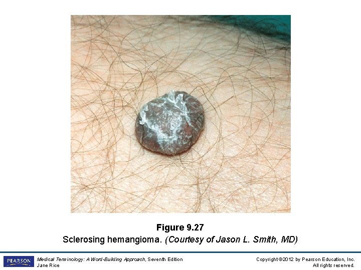 Figure 9. 27 Sclerosing hemangioma. (Courtesy of Jason L. Smith, MD) Medical Terminology: A