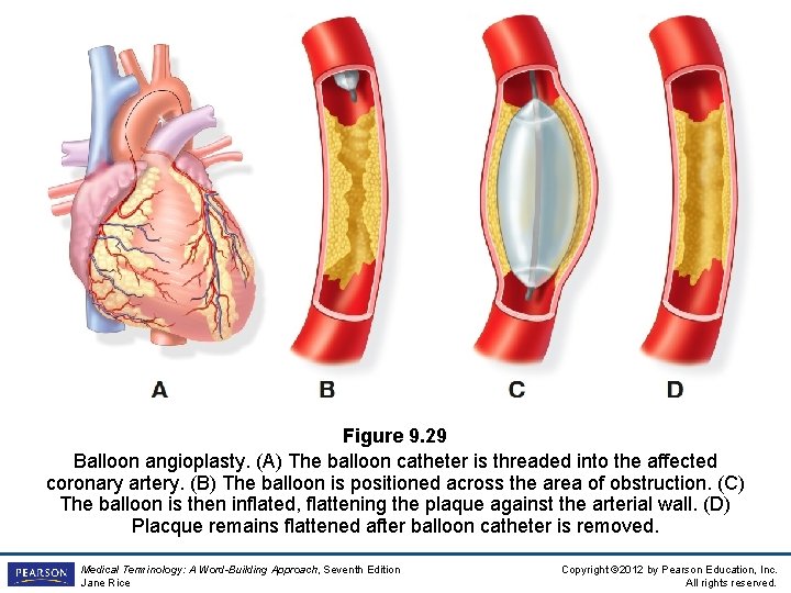 Figure 9. 29 Balloon angioplasty. (A) The balloon catheter is threaded into the affected