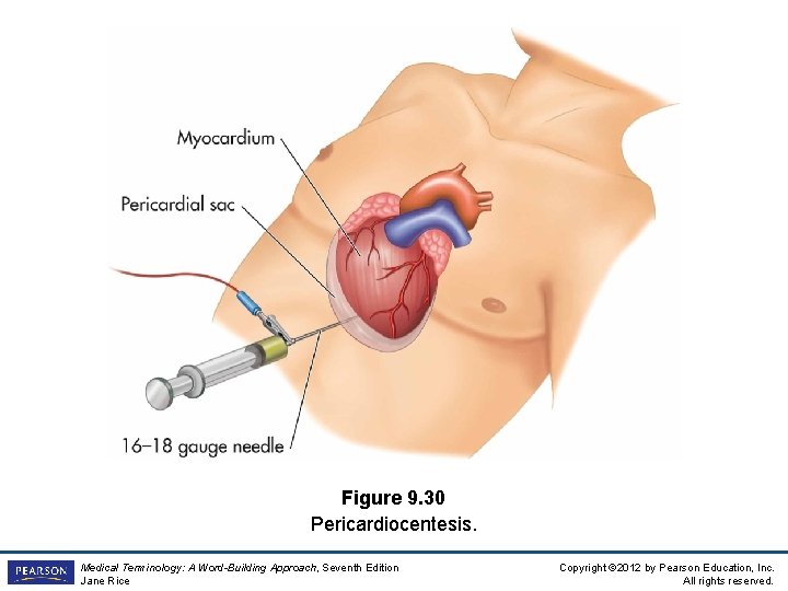 Figure 9. 30 Pericardiocentesis. Medical Terminology: A Word-Building Approach, Seventh Edition Jane Rice Copyright