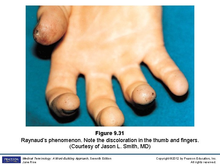 Figure 9. 31 Raynaud’s phenomenon. Note the discoloration in the thumb and fingers. (Courtesy