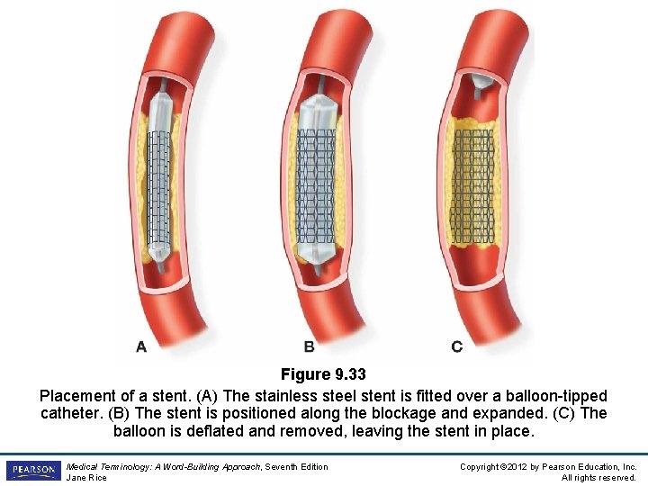 Figure 9. 33 Placement of a stent. (A) The stainless steel stent is fitted