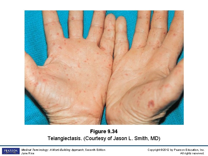 Figure 9. 34 Telangiectasis. (Courtesy of Jason L. Smith, MD) Medical Terminology: A Word-Building