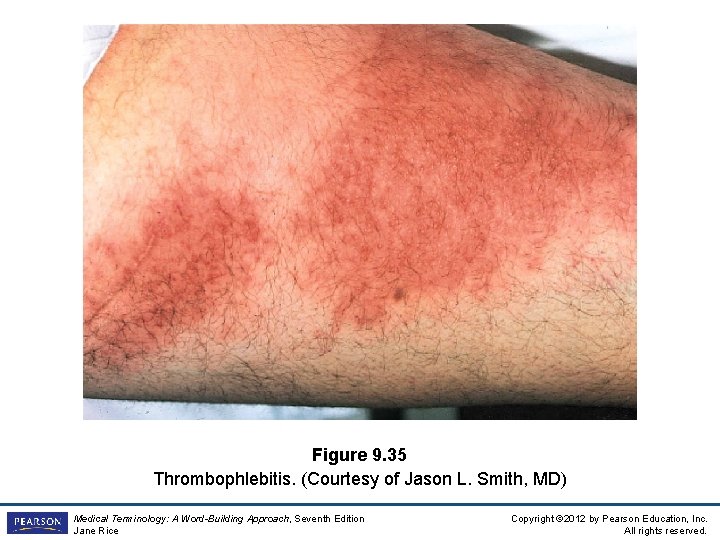 Figure 9. 35 Thrombophlebitis. (Courtesy of Jason L. Smith, MD) Medical Terminology: A Word-Building