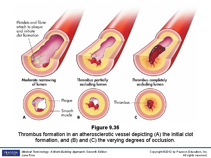 Figure 9. 36 Thrombus formation in an atherosclerotic vessel depicting (A) the initial clot