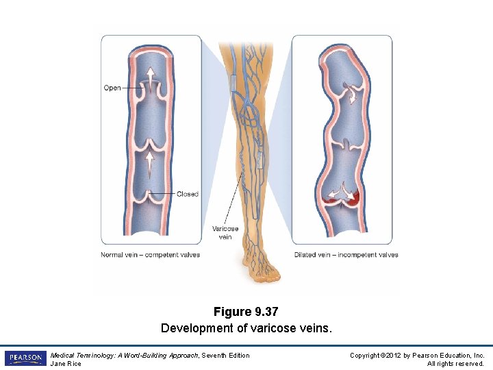 Figure 9. 37 Development of varicose veins. Medical Terminology: A Word-Building Approach, Seventh Edition