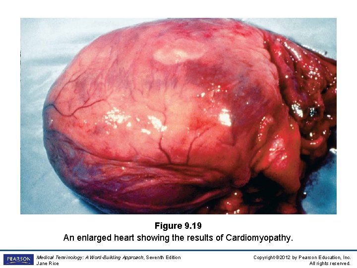 Figure 9. 19 An enlarged heart showing the results of Cardiomyopathy. Medical Terminology: A