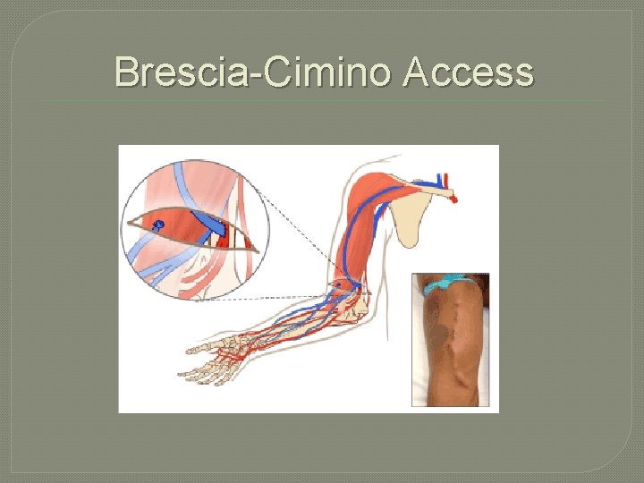 Brescia-Cimino Access 