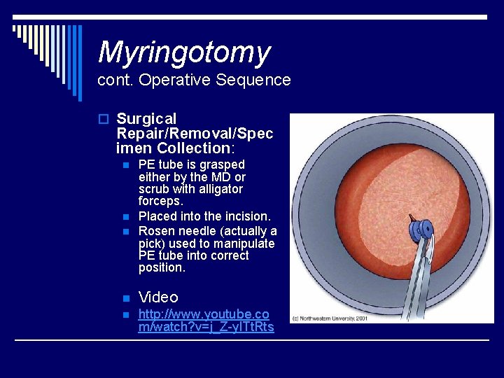 Myringotomy cont. Operative Sequence o Surgical Repair/Removal/Spec imen Collection: n n n PE tube