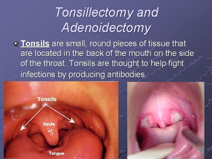 Tonsillectomy and Adenoidectomy Tonsils are small, round pieces of tissue that are located in