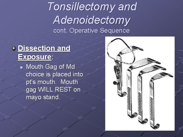 Tonsillectomy and Adenoidectomy cont. Operative Sequence Dissection and Exposure: n Mouth Gag of Md