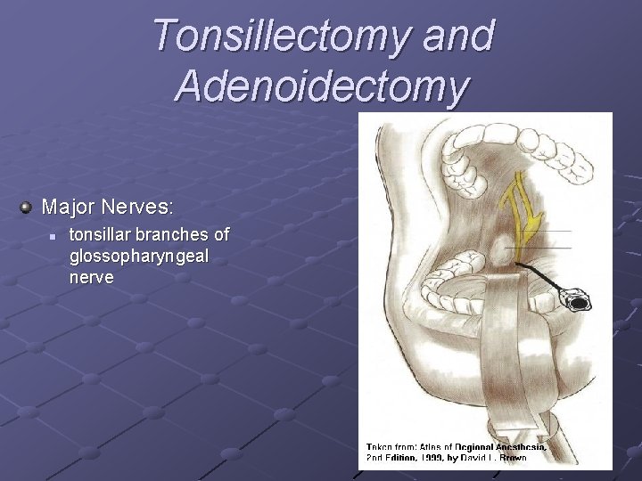 Tonsillectomy and Adenoidectomy Major Nerves: n tonsillar branches of glossopharyngeal nerve 
