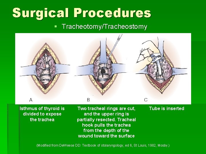 Surgical Procedures § Tracheotomy/Tracheostomy Isthmus of thyroid is divided to expose the trachea Two