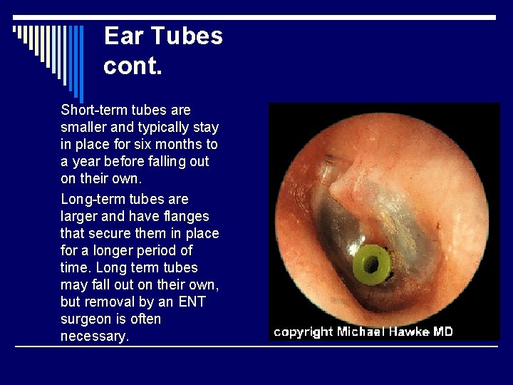 Ear Tubes cont. Short-term tubes are smaller and typically stay in place for six