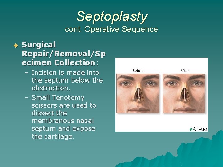 Septoplasty cont. Operative Sequence u Surgical Repair/Removal/Sp ecimen Collection: – Incision is made into