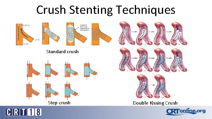 Crush Stenting Techniques Standard crush Step crush Double Kissing Crush 