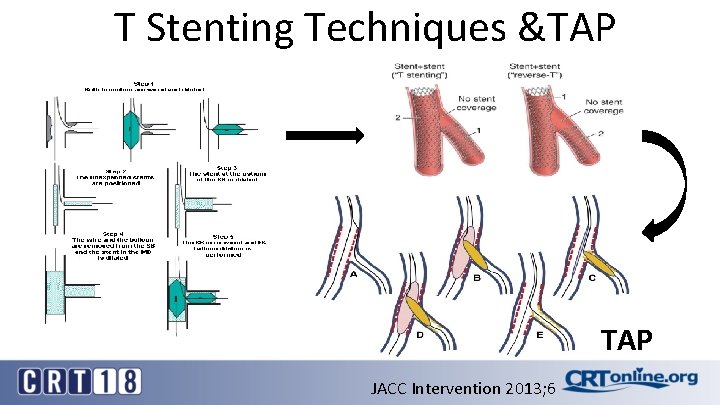 T Stenting Techniques &TAP JACC Intervention 2013; 6 