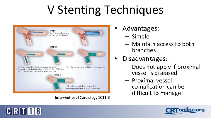 V Stenting Techniques • Advantages: – Simple – Maintain access to both branches •