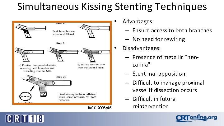 Simultaneous Kissing Stenting Techniques JACC 2005; 46 • Advantages: – Ensure access to both