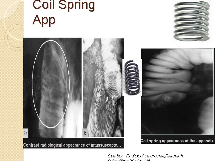 Coil Spring App Sumber : Radiologi emergensi, Ristaniah 