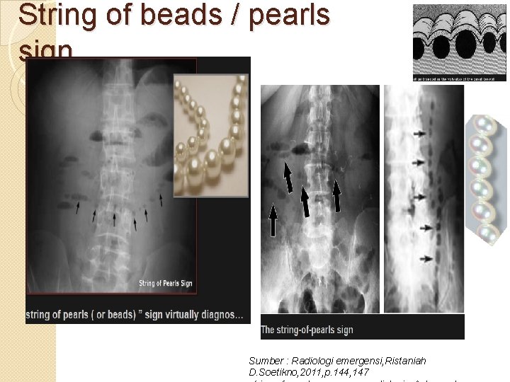 String of beads / pearls sign Sumber : Radiologi emergensi, Ristaniah D. Soetikno, 2011,