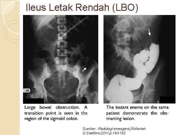 Ileus Letak Rendah (LBO) Sumber : Radiologi emergensi, Ristaniah D. Soetikno, 2011, p. 140
