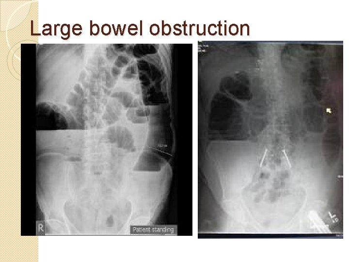 Large bowel obstruction 