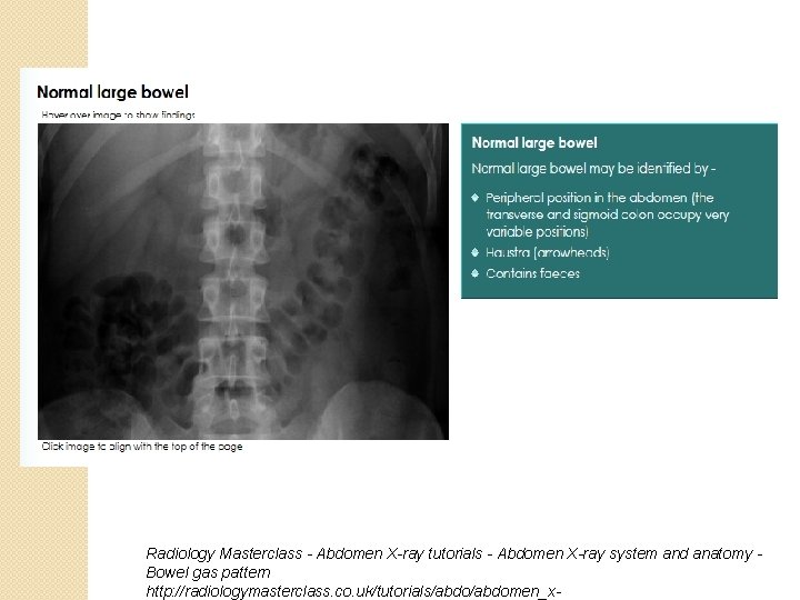 Radiology Masterclass - Abdomen X-ray tutorials - Abdomen X-ray system and anatomy Bowel gas