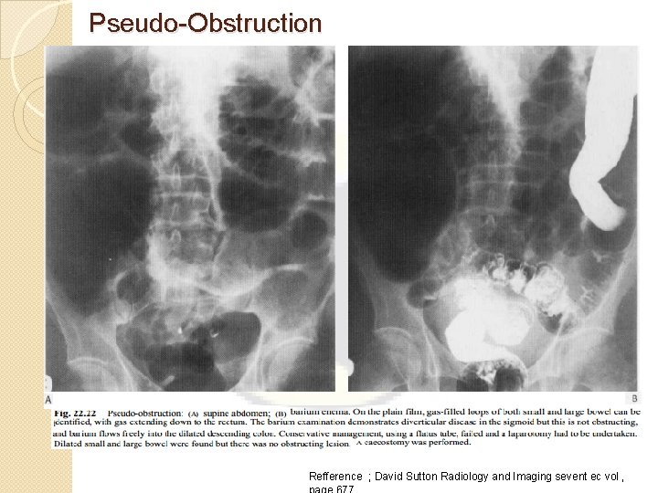 Pseudo-Obstruction Refference ; David Sutton Radiology and Imaging sevent ec vol , 