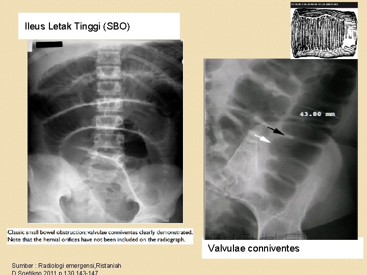 Ileus Letak Tinggi (SBO) Valvulae conniventes Sumber : Radiologi emergensi, Ristaniah 