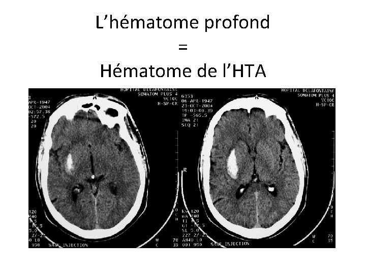 L’hématome profond = Hématome de l’HTA 