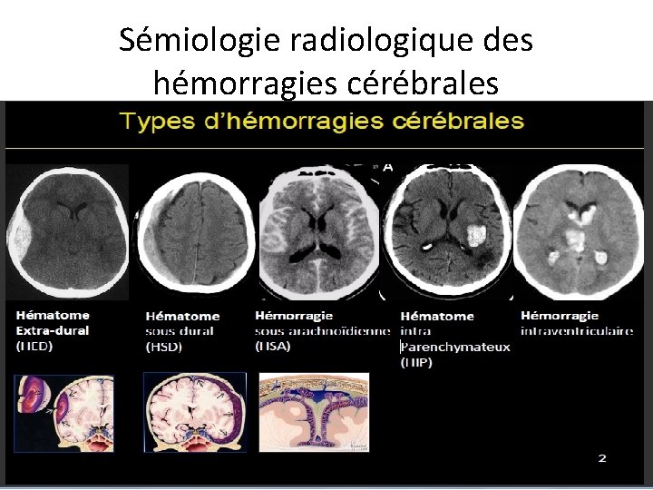 Sémiologie radiologique des hémorragies cérébrales 