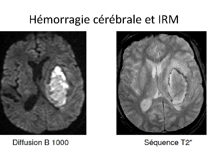 Hémorragie cérébrale et IRM 