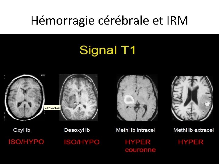 Hémorragie cérébrale et IRM 