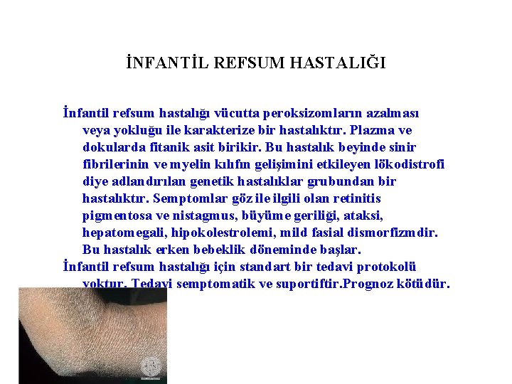 İNFANTİL REFSUM HASTALIĞI İnfantil refsum hastalığı vücutta peroksizomların azalması veya yokluğu ile karakterize bir