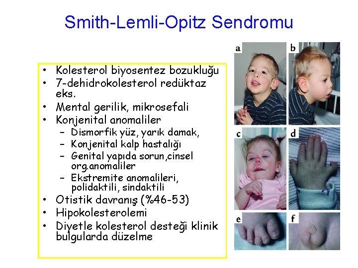Smith-Lemli-Opitz Sendromu • Kolesterol biyosentez bozukluğu • 7 -dehidrokolesterol redüktaz eks. • Mental gerilik,