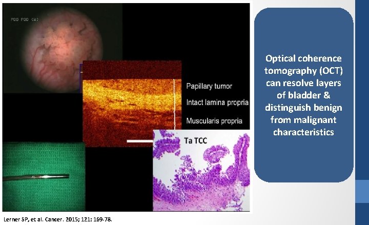 Optical coherence tomography (OCT) can resolve layers of bladder & distinguish benign from malignant