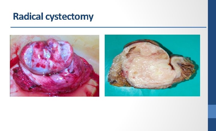 Radical cystectomy 