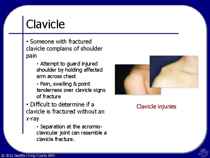 Clavicle • Someone with fractured clavicle complains of shoulder pain • Attempt to guard