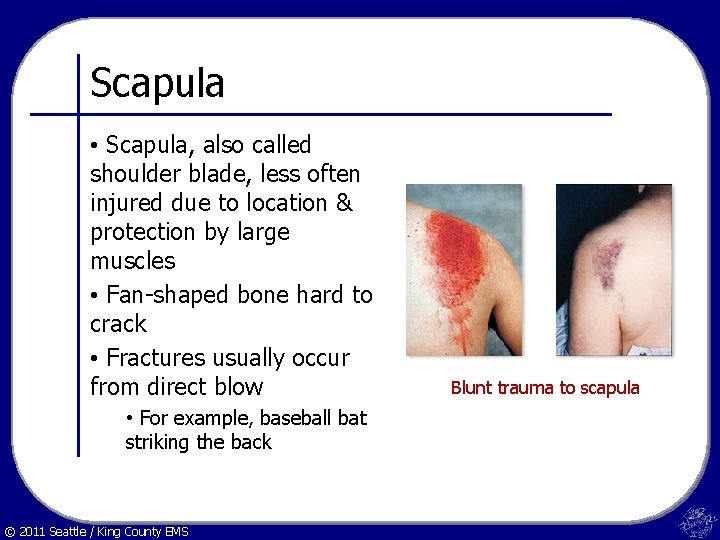 Scapula • Scapula, also called shoulder blade, less often injured due to location &