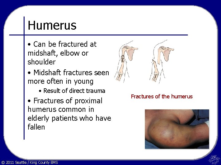 Humerus • Can be fractured at midshaft, elbow or shoulder • Midshaft fractures seen