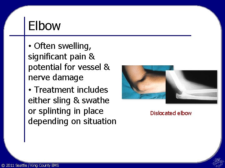 Elbow • Often swelling, significant pain & potential for vessel & nerve damage •