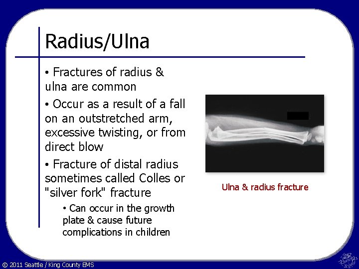 Radius/Ulna • Fractures of radius & ulna are common • Occur as a result