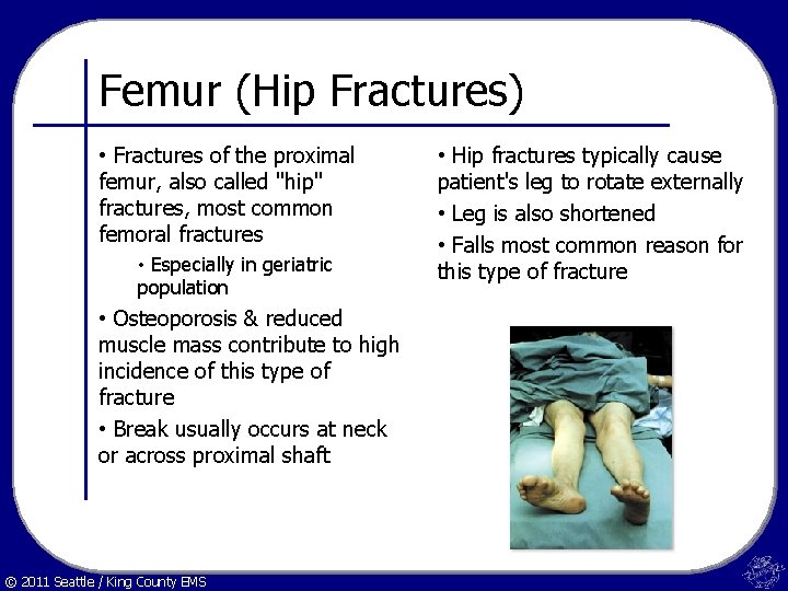 Femur (Hip Fractures) • Fractures of the proximal femur, also called "hip" fractures, most