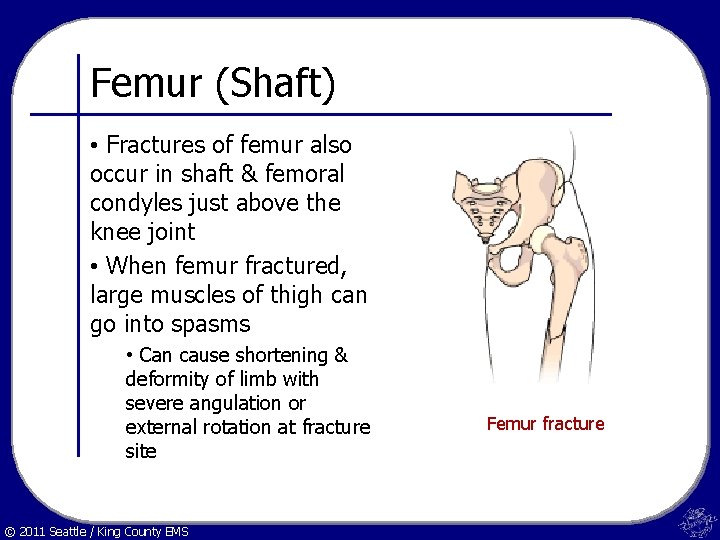 Femur (Shaft) • Fractures of femur also occur in shaft & femoral condyles just