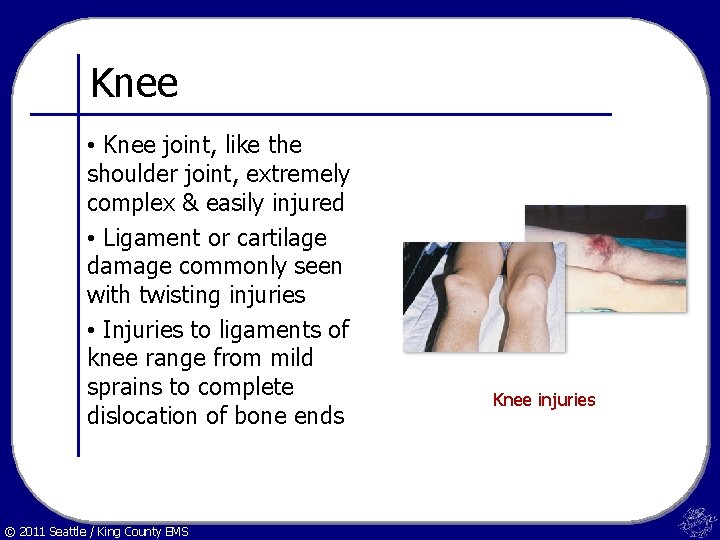 Knee • Knee joint, like the shoulder joint, extremely complex & easily injured •