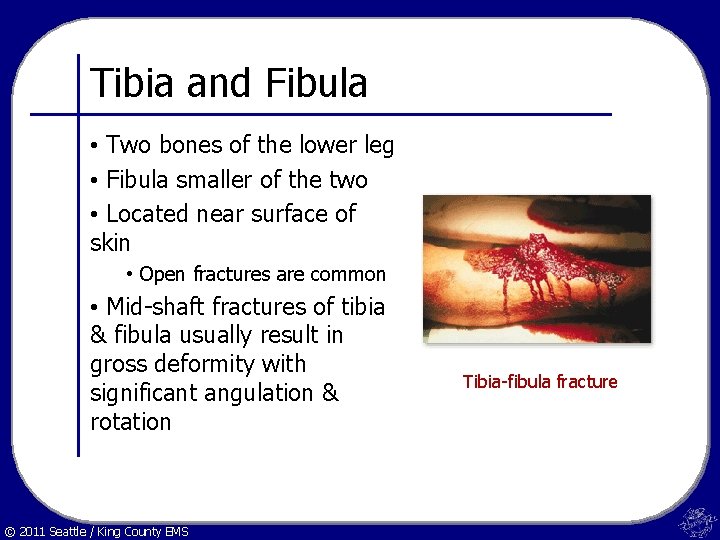 Tibia and Fibula • Two bones of the lower leg • Fibula smaller of