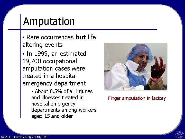 Amputation • Rare occurrences but life altering events • In 1999, an estimated 19,