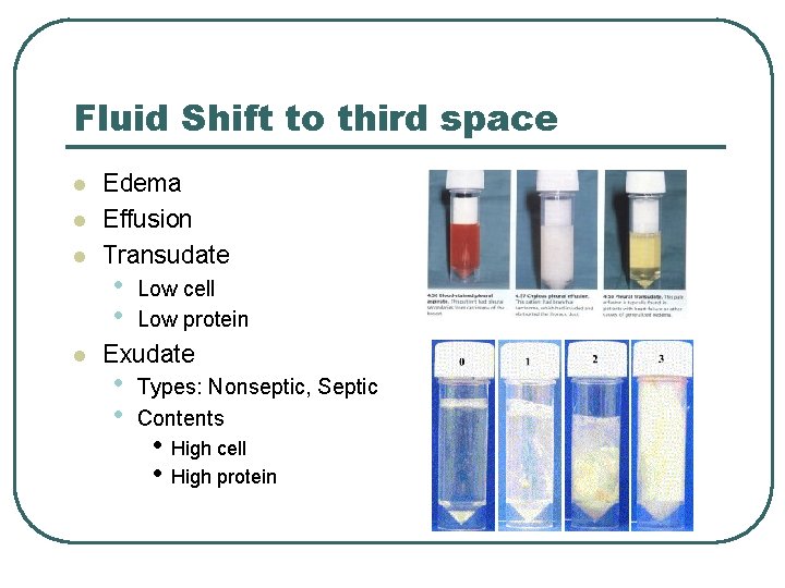 Fluid Shift to third space l l Edema Effusion Transudate • • Low cell